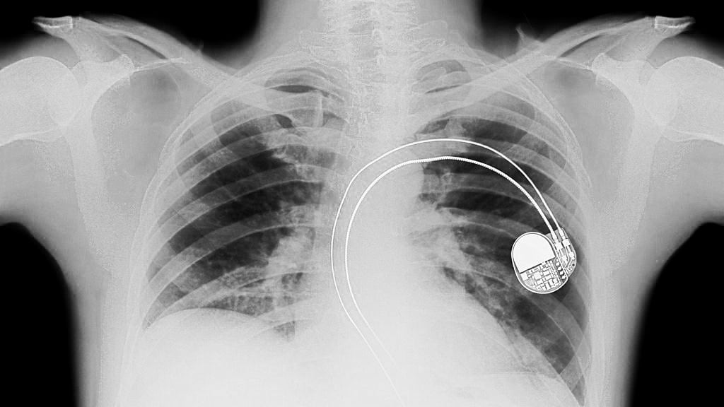 Welding Safety 101: Welding and Pacemakers – Baker's Gas & Welding ...